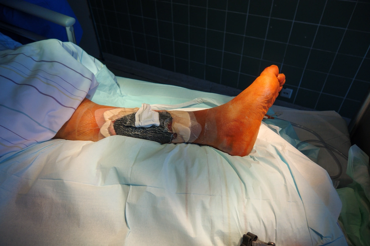 Terapia a Pressione Negativa Cutanea: Come Funziona e Quando Utilizzarla